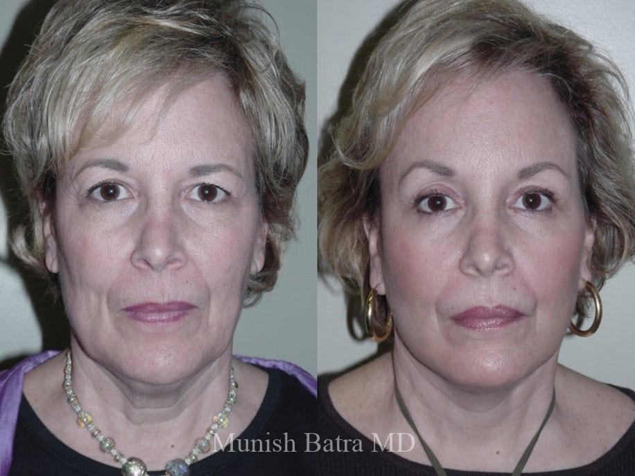 Before and After Image