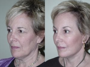 Before and After Image