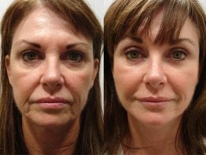 Before and After Image