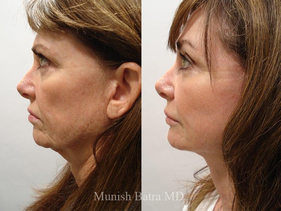 Before and After Image