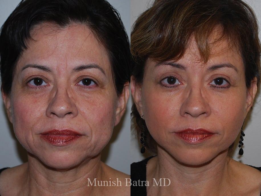 Before and After Image