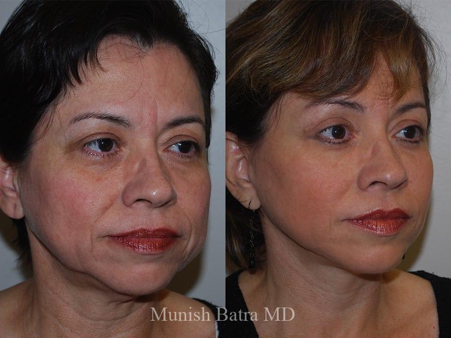 Before and After Image