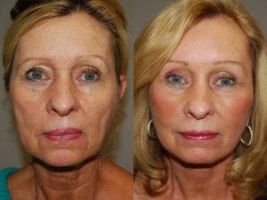 Before and After Image