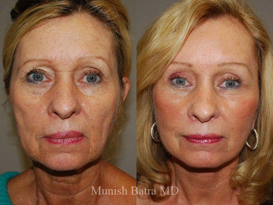 Before and After Image