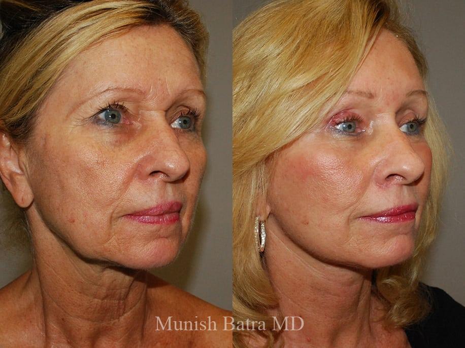 Before and After Image