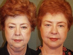 Before and After Image