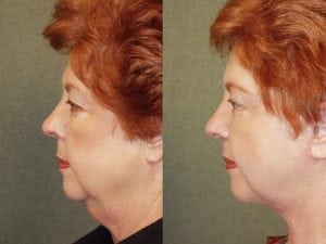 Before and After Image