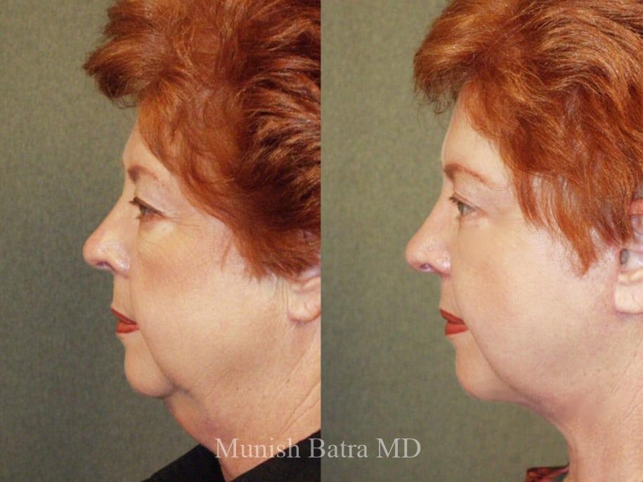 Before and After Image