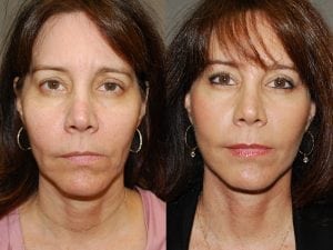 Before and After Image