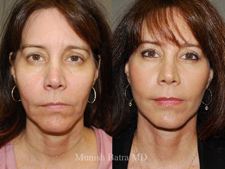 Before and After Image