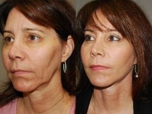 Before and After Image
