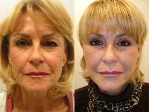 Before and After Image