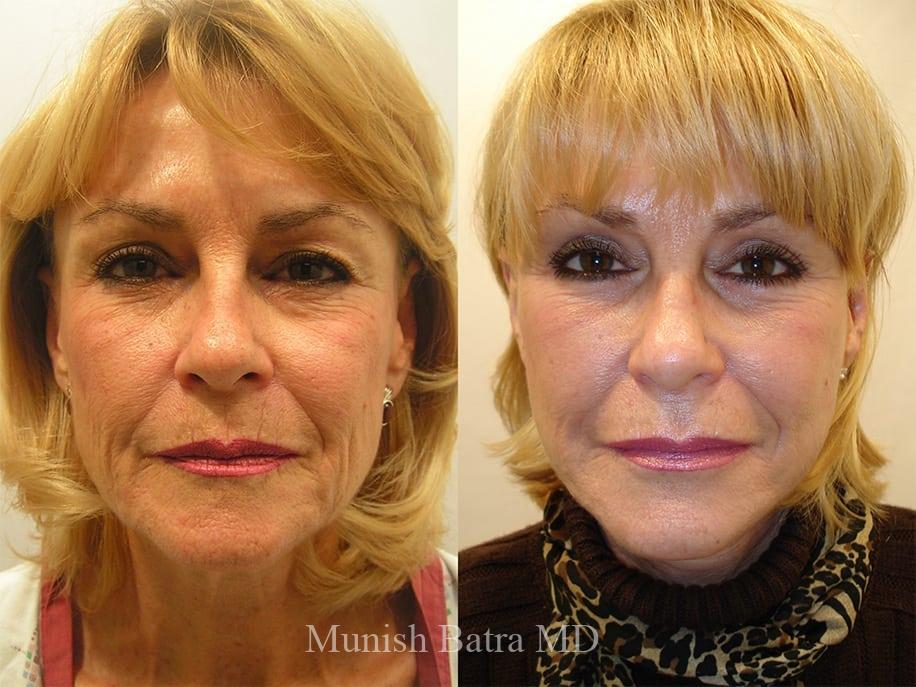 Before and After Image