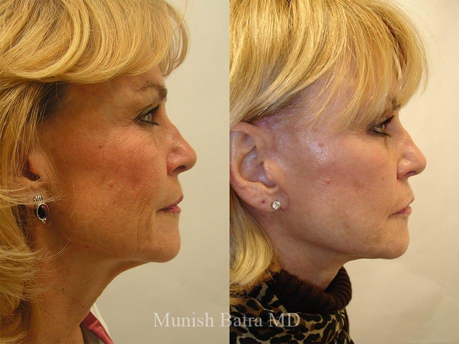 Before and After Image