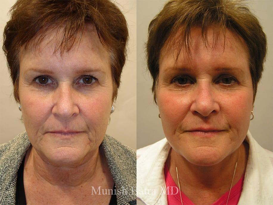 Before and After Image
