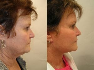 Before and After Image