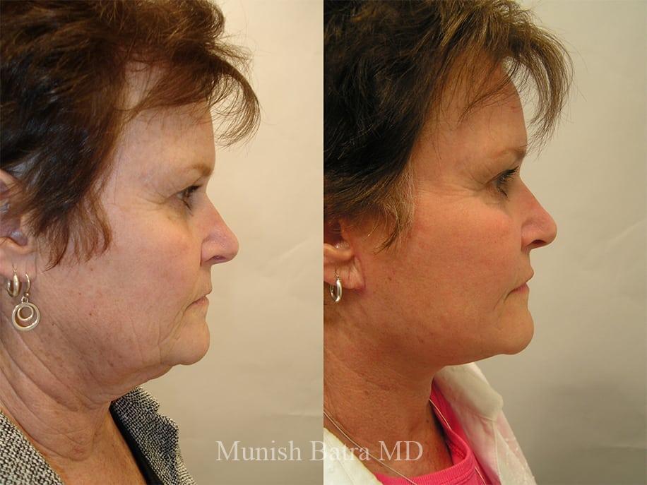 Before and After Image