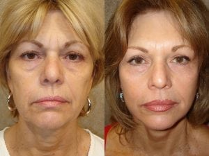 Before and After Image