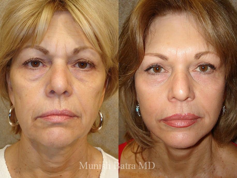 Before and After Image