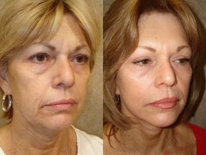 Before and After Image