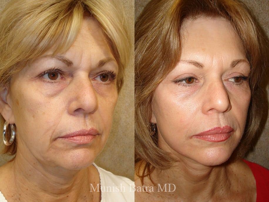 Before and After Image