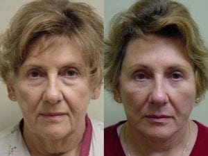 Before and After Image