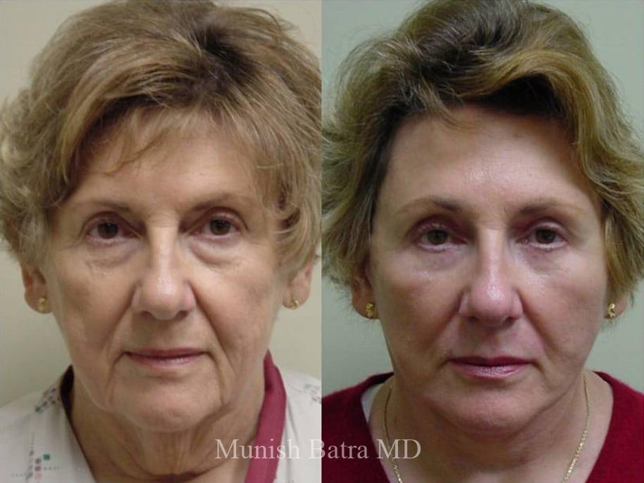 Before and After Image