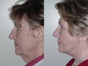 Before and After Image