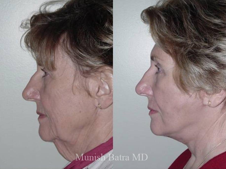 Before and After Image