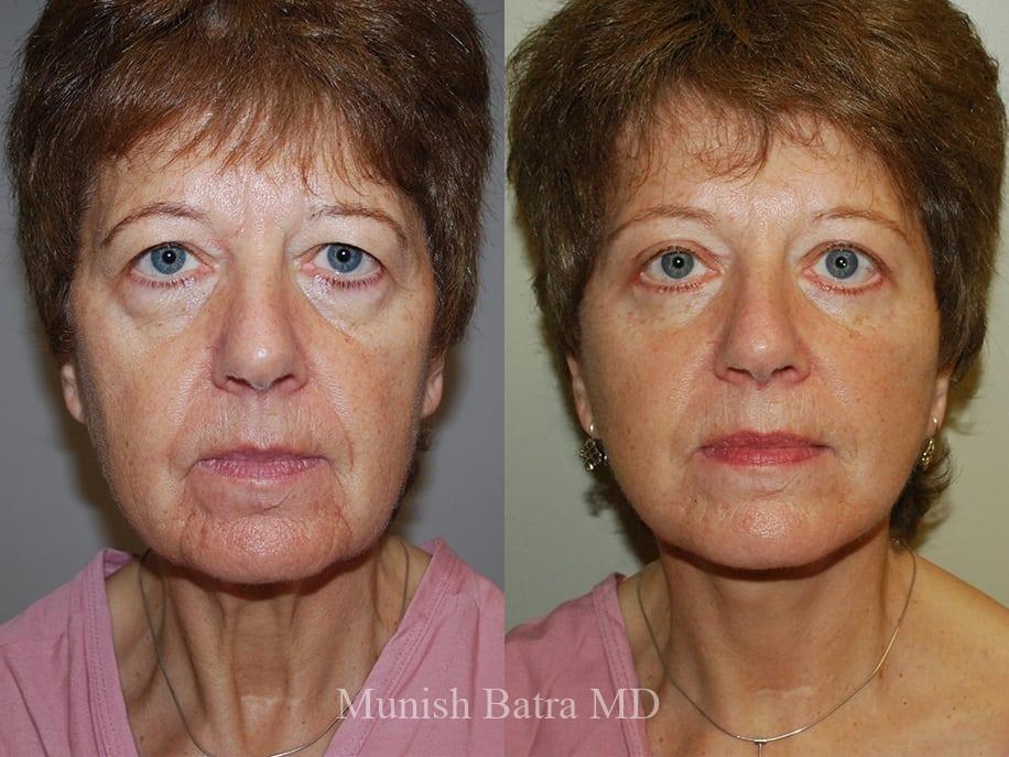 Before and After Image