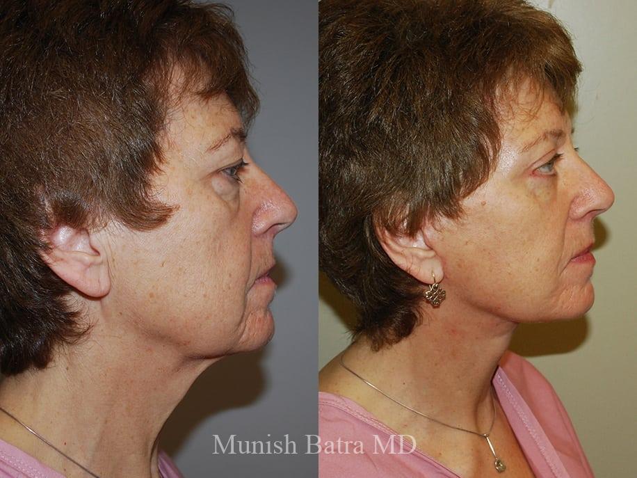 Before and After Image