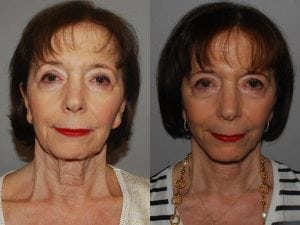 Before and After Image
