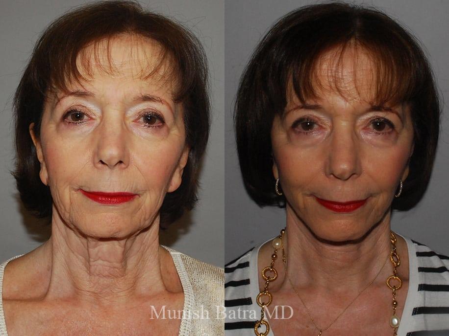 Before and After Image