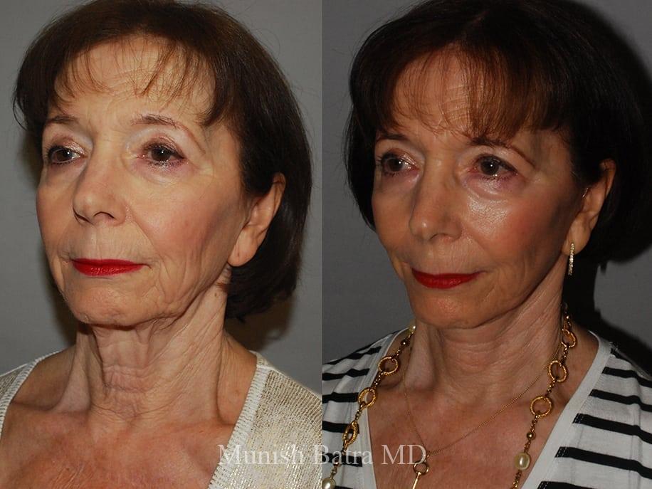 Before and After Image