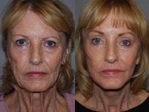 Before and After Image