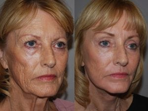 Before and After Image