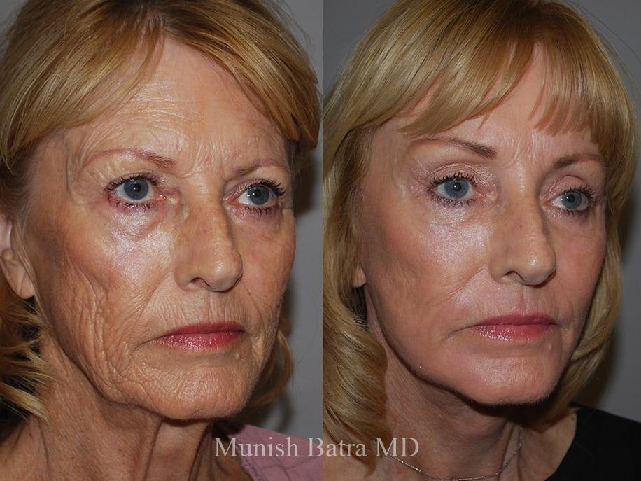 Before and After Image