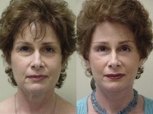 Before and After Image