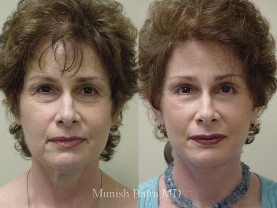 Before and After Image