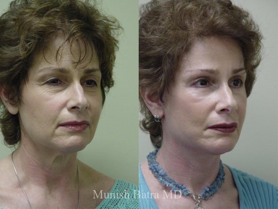 Before and After Image