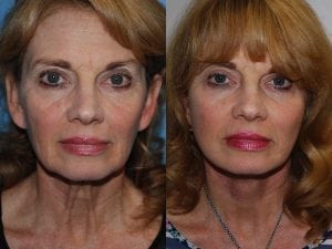 Before and After Image