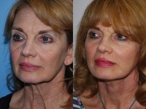 Before and After Image