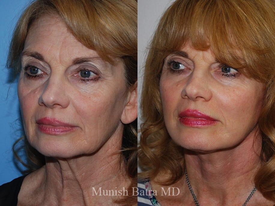 Before and After Image