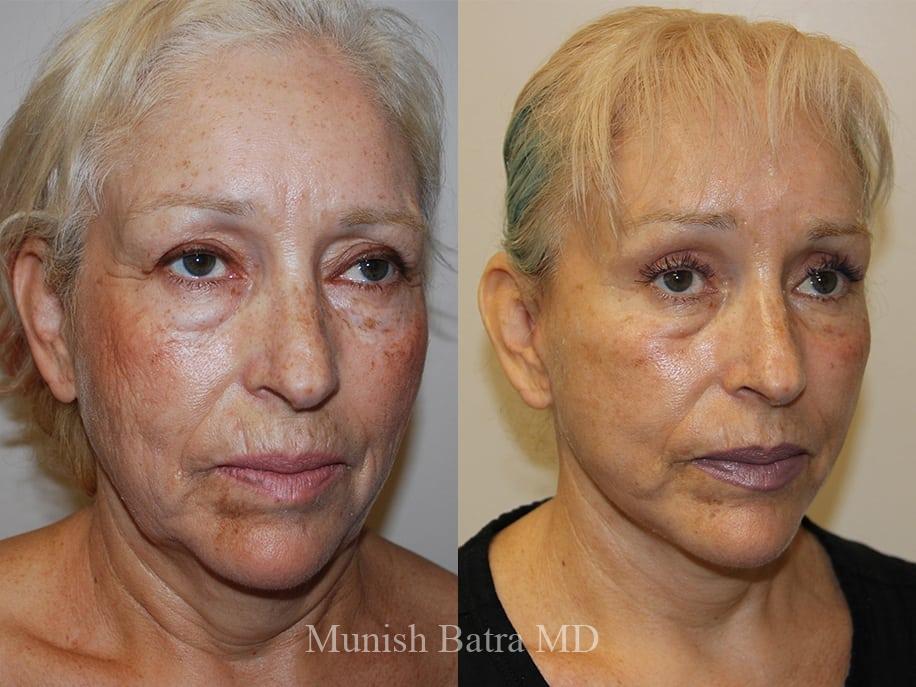 Before and After Image