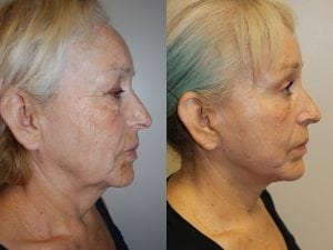 Before and After Image