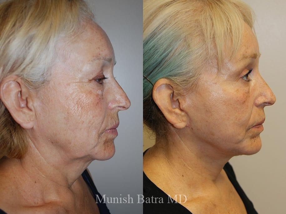 Before and After Image