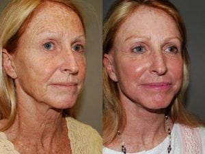 Before and After Image