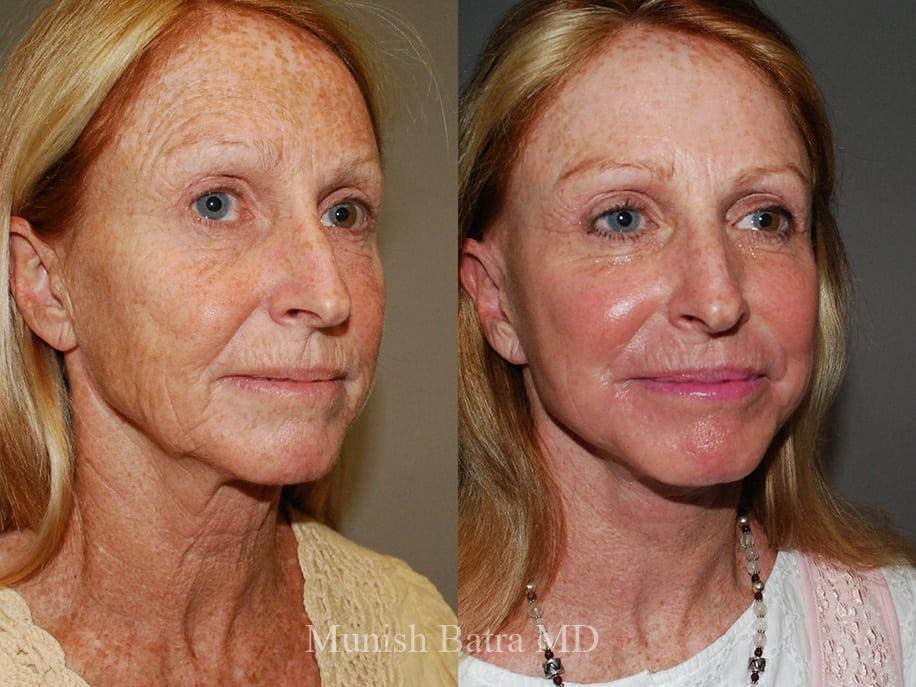 Before and After Image