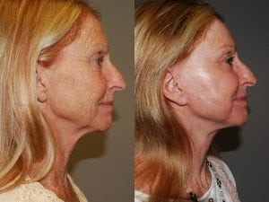 Before and After Image