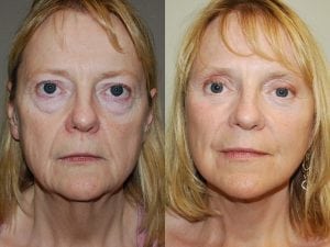 Before and After Image